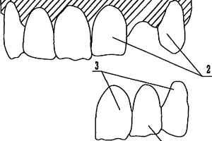 用于修復(fù)個(gè)別前牙缺失的新型粘接橋