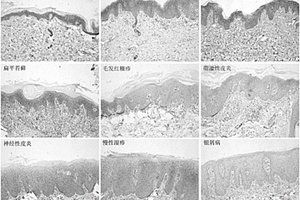 皮膚離體樣本的免疫組織化學染色檢測galectin-3 輔助診斷銀屑病的方法