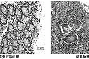 結(jié)直腸癌標(biāo)志物及其應(yīng)用